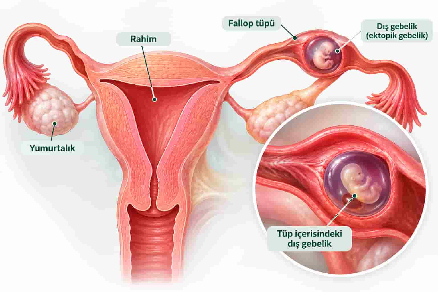 Ektopik Gebelik (Dış Gebelik): Belirtileri, Tanısı