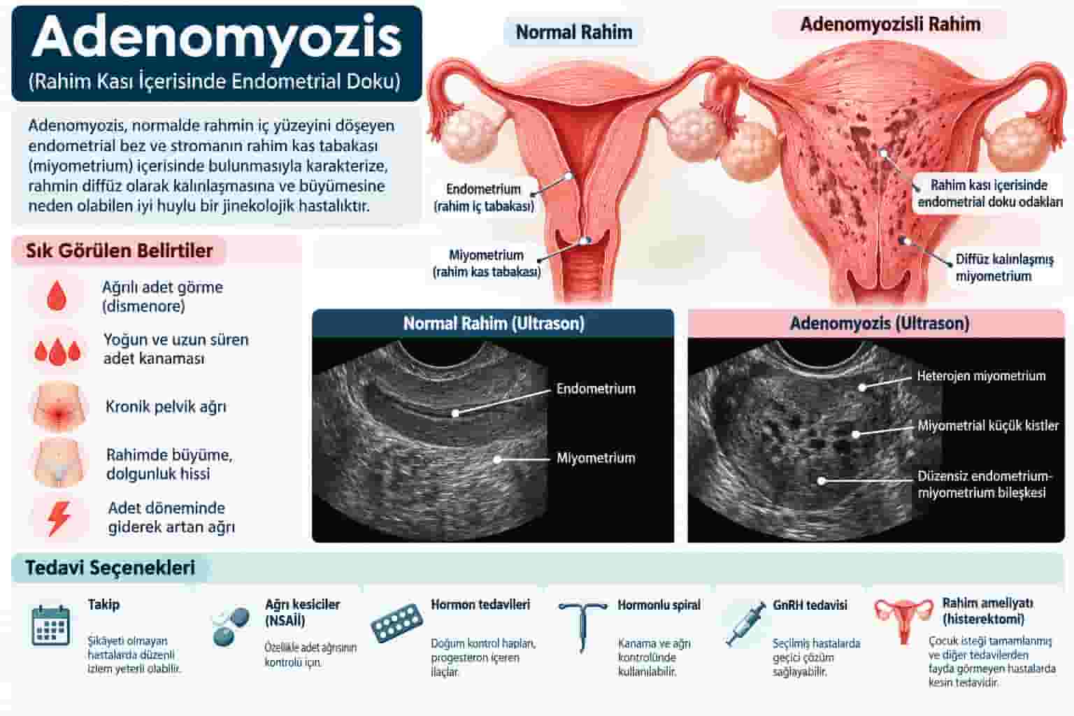 Adenomyozis Nedir? Belirtileri, Tanısı ve Tedavisi