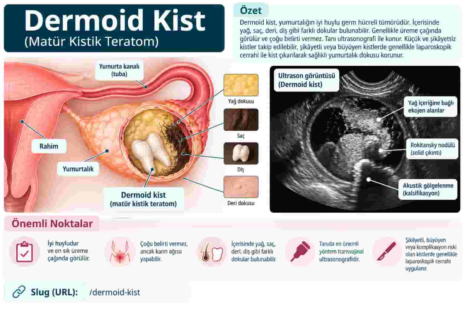 Dermoid Kist (Matür Kistik Teratom): Belirtileri, Tanısı ve Tedavisi