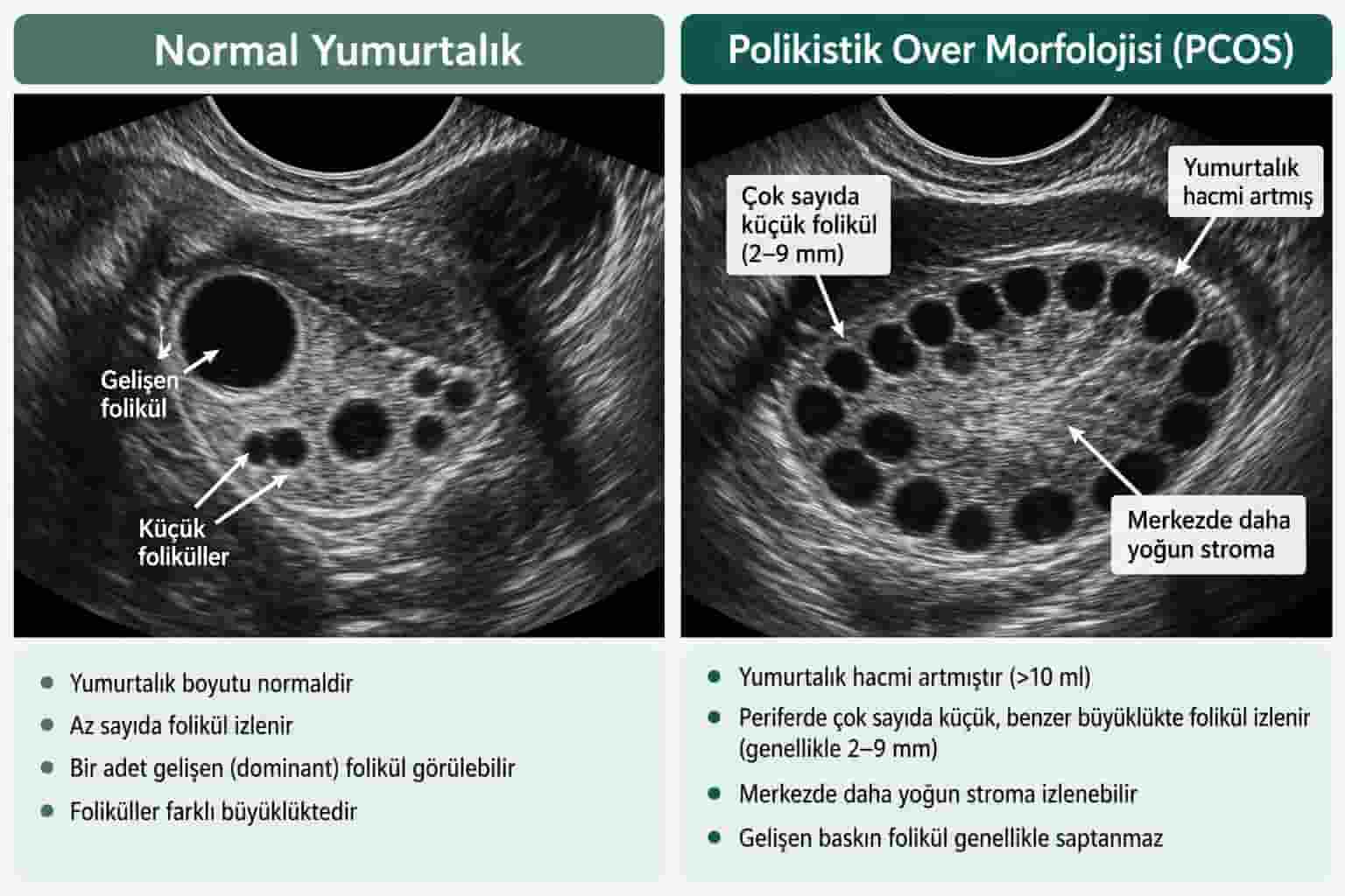 PMOS (Eski Adıyla PCOS): Poliendokrin Metabolik Over Sendromu Belirtileri, Tanısı ve Tedavisi