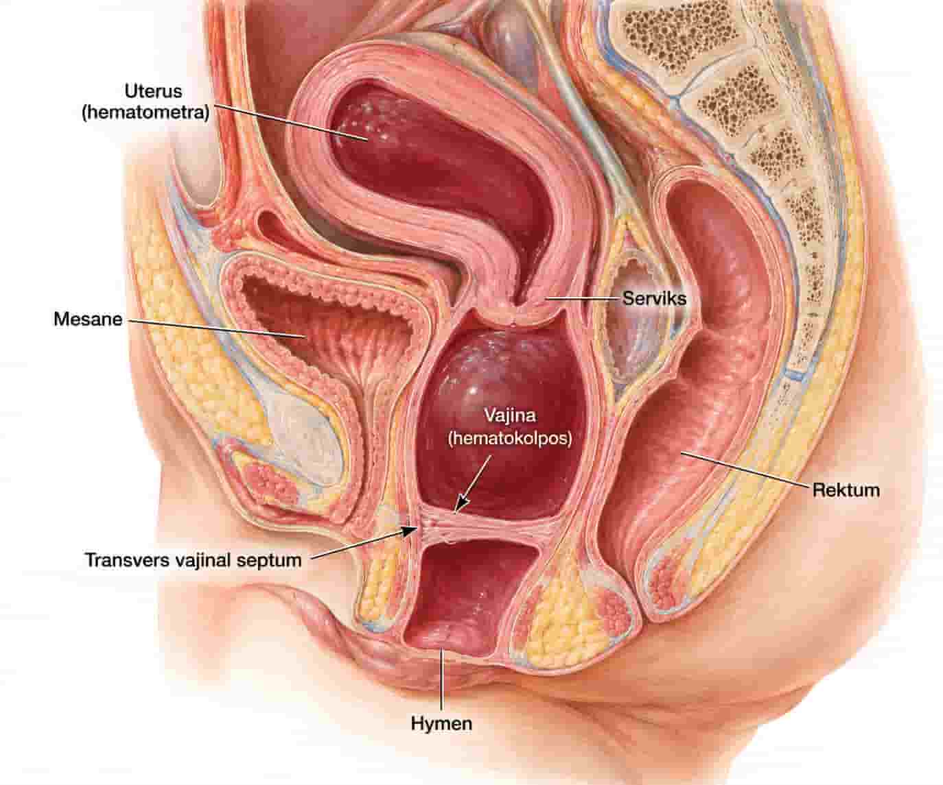 Vajinal Septum Nedir? Transvers ve Longitudinal Vajinal Septum