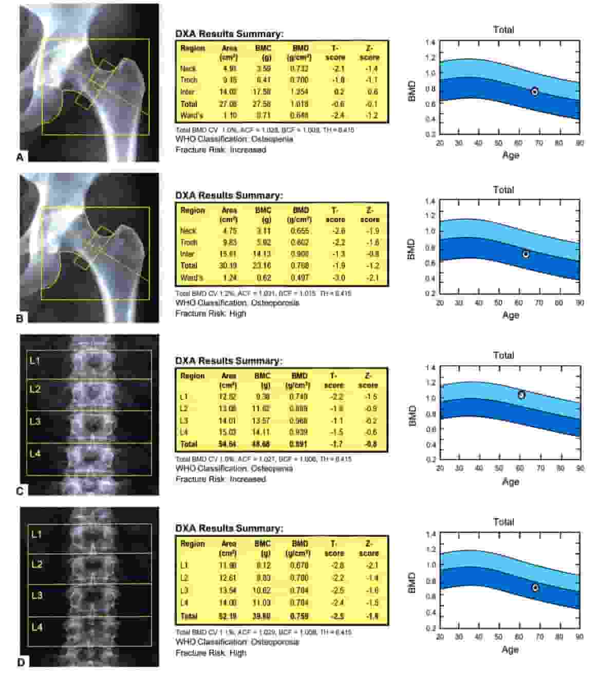 Menopozda Kemik Erimesi ve Osteoporoz: Belirtileri, DEXA Ölçümü, Korunma ve Tedavi